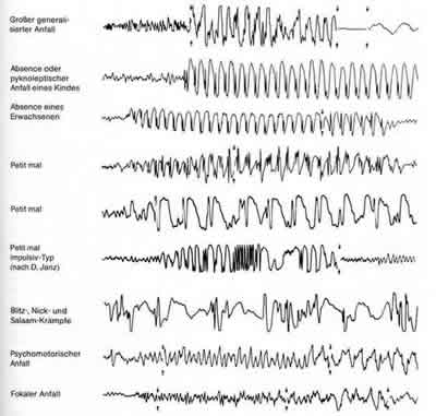 EEG-Kurvenausschnitte mit typischen Mustern unterschiedlicher Anfallsformen